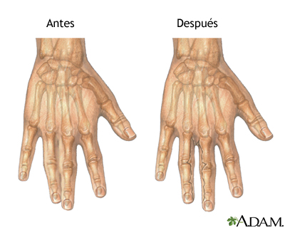 Antes y después de reparación de sindactilia