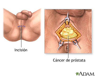 Incisión