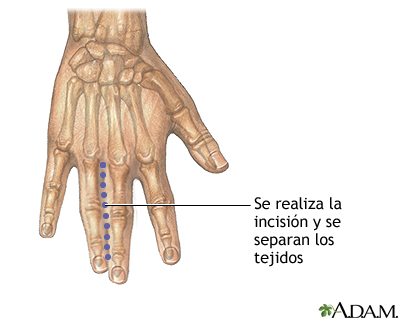 Incisión