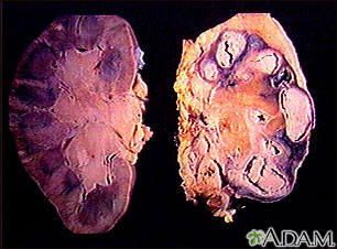 Tuberculosis renal