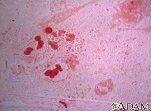 Haemophilus influenzae