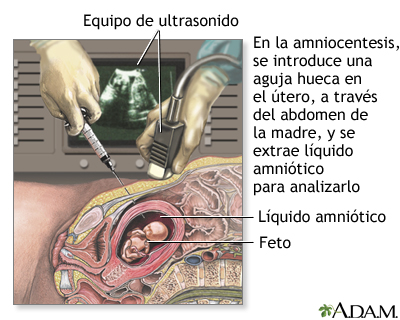 Amniocentesis