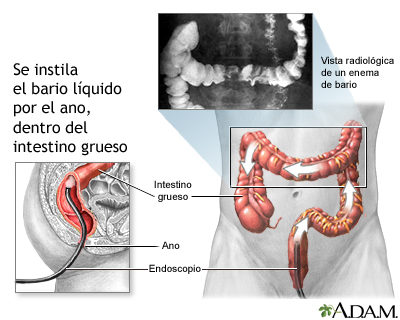 Enema de bario