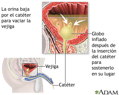 Cateterización de la vejiga en el hombre