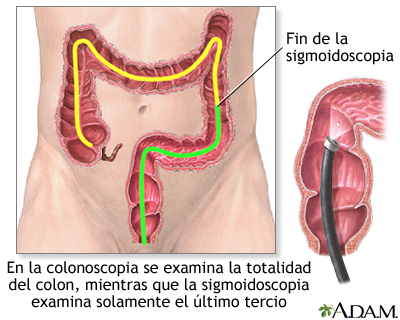 Colonoscopia