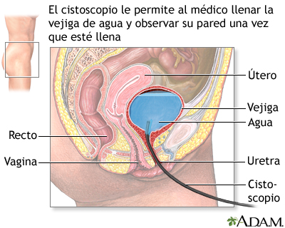 Cistoscopia