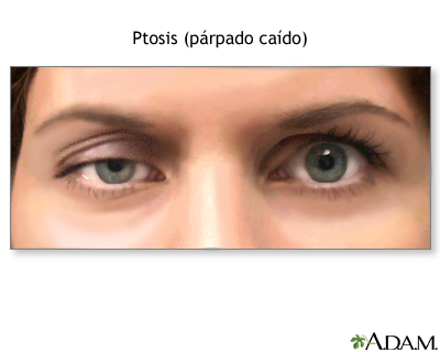 Descenso del párpado por ptosis