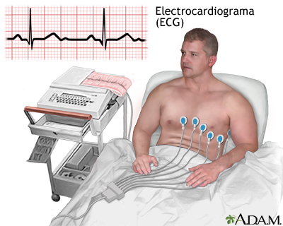 ECG