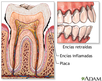 Gingivitis