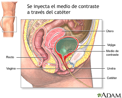 Cistouretrograma de eliminación