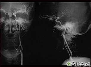 Estenosis carotídea; radiografía de la arteria izquierda