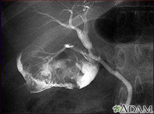 Colangiograma de una colecistitis