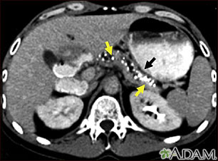 Tomografía computarizada de una pancreatitis crónica