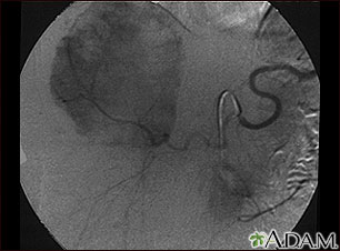 Angiograma de hemangioma