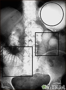 Ileo: Radiografía del estómago e intestino distendido