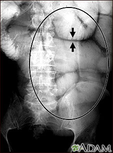 Ileo: Radiografía de la distensión intestinal