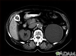 Quiste renal con cálculos biliares; TC