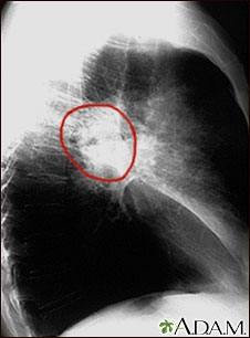 Cáncer de pulmón- Radiografía lateral del tórax