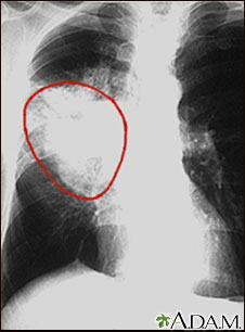 Cáncer de pulmón -Radiografía frontal del tórax