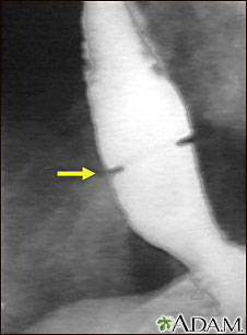 Radiograf&#237;a del anillo de Schatzki