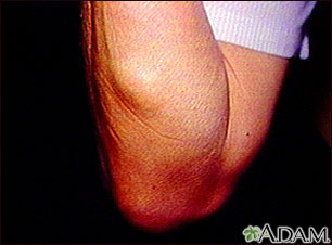 Lipoma en el brazo