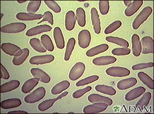 Glóbulos rojos con eliptocitosis