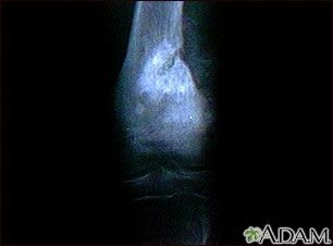 Rayos X de un sarcoma osteogénico