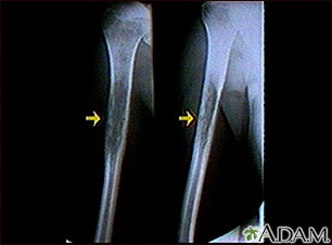 Rayos X de un sarcoma de Ewing