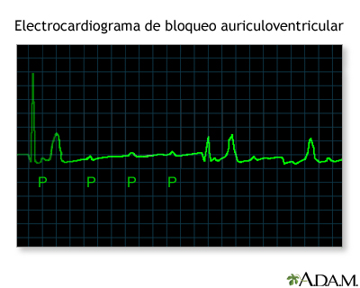 Registro del ECG durante un bloqueo auriculoventricular