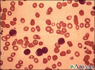 Leucemia linfocítica crónica; vista microscópica