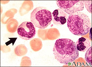 Vista microscópica: leucemia mielocítica crónica