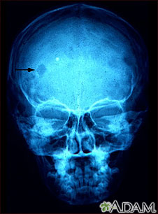 Granuloma eosinofílico- Radiografía del cráneo