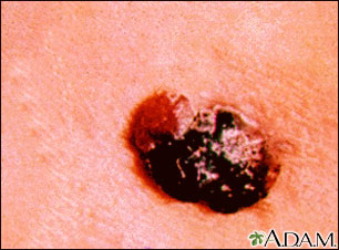 Cáncer de piel o melanoma multicolor en relieve