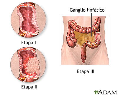 Incisión