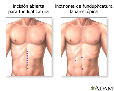 Incisión