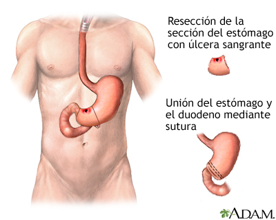 Procedimiento (tercera parte)