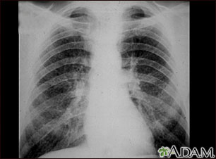 Neumoconiosis del minero en etapa II