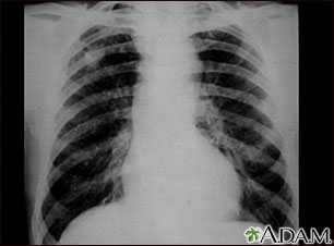 Neumoconiosis del minero, Etapa II #2