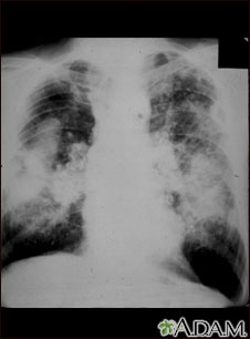 Neumoconiosis en trabajadores del carbón; complicada #2