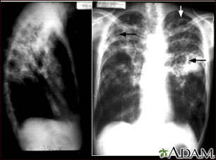 Tuberculosis avanzada, radiografía de tórax