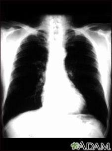 Cáncer bronquial - radiografía de tórax