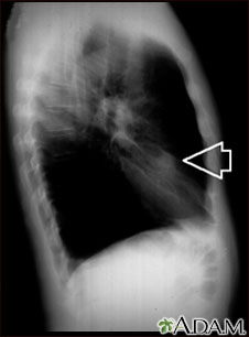 Nódulo pulmonar, lóbulo medio derecho- Radiografía de tórax