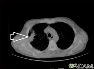 Masa pulmonar, pulmón derecho - Tomografía.