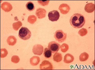 Eritroblastosis fetal- foto micrografía