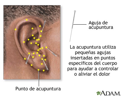 Acupuntura