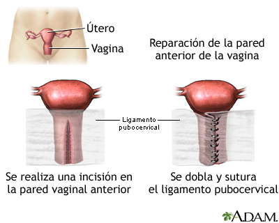 Reparación de la pared vaginal anterior