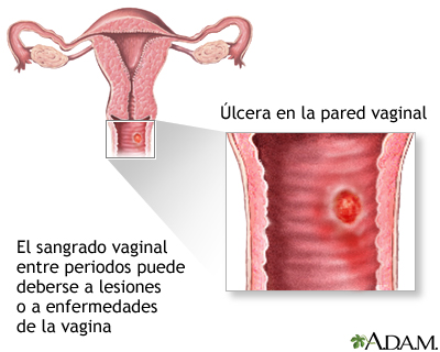 Sangrado entre periodos