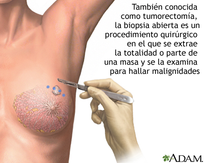 Biopsia abierta del seno