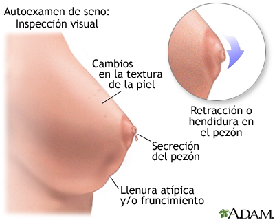 Autoexamen de seno