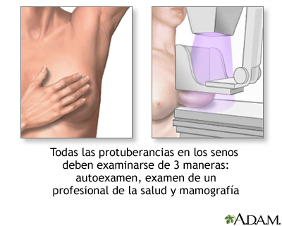 Protuberancias mamarias